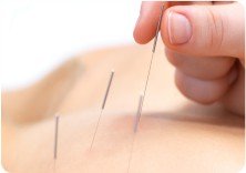 dry needling